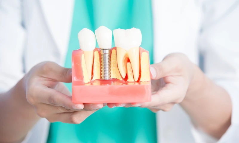 インプラントについて